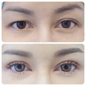 ทำตาสองชั้น_แก้หนังตาตก_31