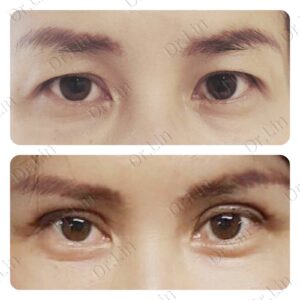 ทำตาสองชั้น_แก้หนังตาตก_49