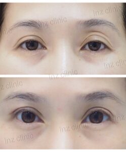 ทำตาสองชั้น_แก้หนังตาตก_52