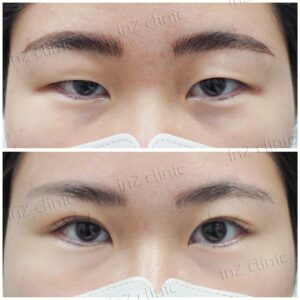 ศัลยกรรมตาโต_เย็บกล้ามเนื้อตา_162
