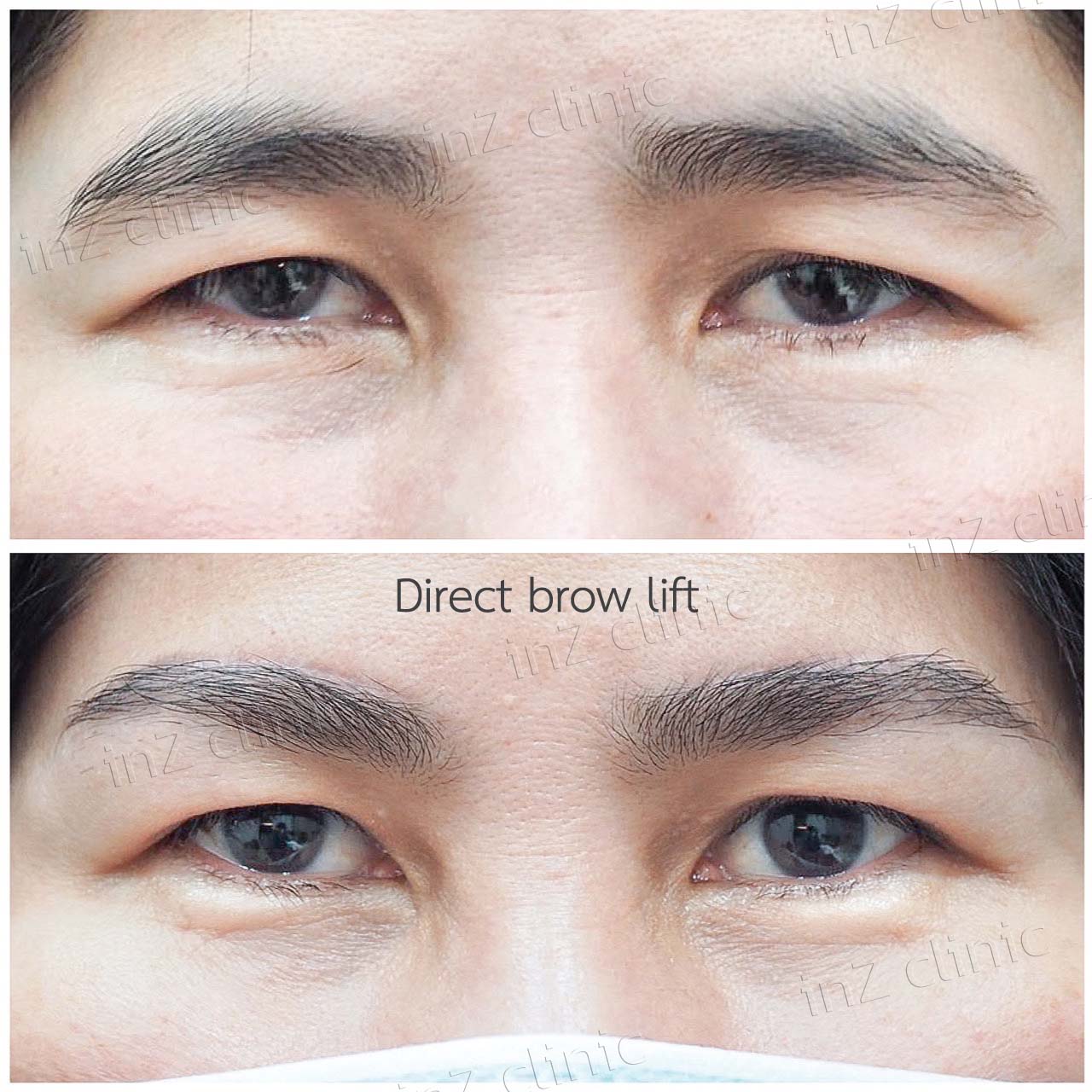 รีวิวยกคิ้ว Direct brow lifting_01