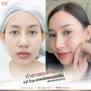 ทำตาสองชั้นทีมแพทย์ Upper-Blepharoplasty-54