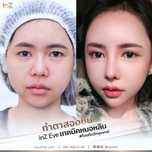 ทำตาสองชั้นทีมแพทย์ Upper-Blepharoplasty-53