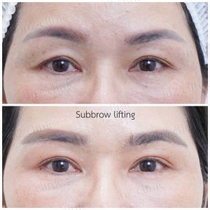 Direct brow lifting-Subbrow Lifting-inzclinic-13