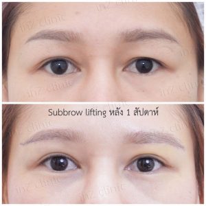 Direct brow lifting-Subbrow Lifting-inzclinic-12