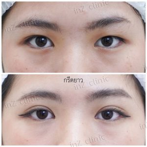 ทำตาสองชั้นทีมแพทย์ Upper-Blepharoplasty-52