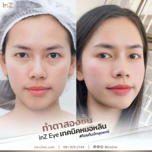 ทำตาสองชั้นทีมแพทย์ Upper-Blepharoplasty-51