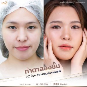 ทำตาสองชั้นทีมแพทย์ Upper-Blepharoplasty-50