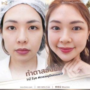 ทำตาสองชั้นทีมแแพทย์ Upper-Blepharoplasty-49