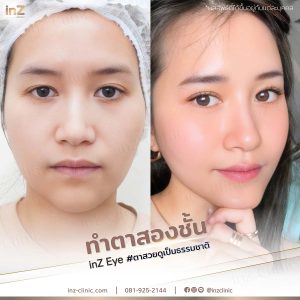 ทำตาสองชั้นทีมแพทย์ Upper-Blepharoplasty-48