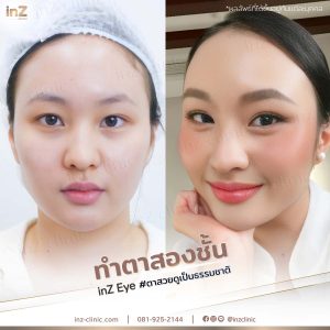 ทำตาสองชั้นทีมแพทย์ Upper-Blepharoplasty-47