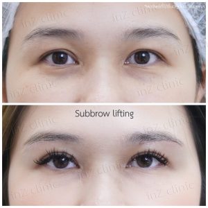 Direct brow lifting-Subbrow Lifting-inzclinic-15