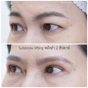 Direct brow lifting-Subbrow Lifting-inzclinic-16