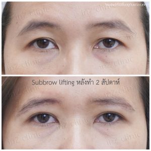 Direct brow lifting-Subbrow Lifting-inzclinic-17