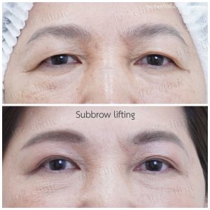 Direct brow lifting-Subbrow Lifting-inzclinic-18