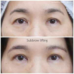 Direct brow lifting-Subbrow Lifting-inzclinic-19