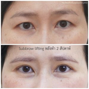 Direct brow lifting-Subbrow Lifting-inzclinic-20