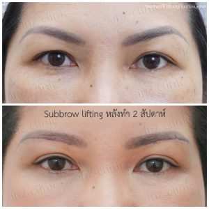 Direct brow lifting-Sbrow Lifting-inzclinic-21