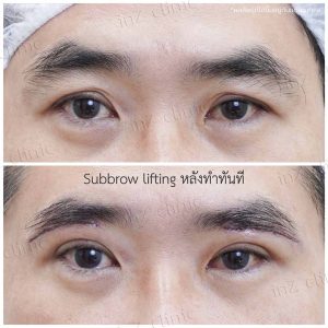 Direct brow lifting-Subbrow Lifting-inzclinic-22