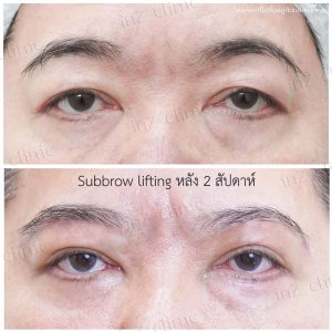 Direct brow lifting-Subbrow Lifting-inzclinic-23