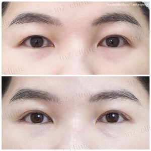 ทำตาสองชั้นทีมแแพทย์ Upper-Blepharoplasty-45