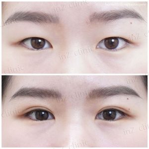 ทำตาสองชั้นทีมแพทย์ Upper-Blepharoplasty-44