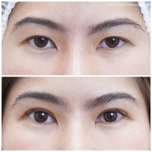 ทำตาสองชั้นทีมแพทย์ Upper-Blepharoplasty-43