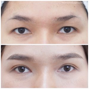 ทำตาสองชั้นทีมแพทย์ Upper-Blepharoplasty-46