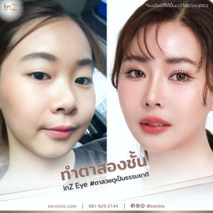 ทำตาสองชั้นทีมแทย์ Upper-Blepharoplasty-42