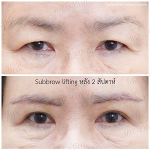 Direct brow lifting-Subbrow Lifting-inzclinic-24