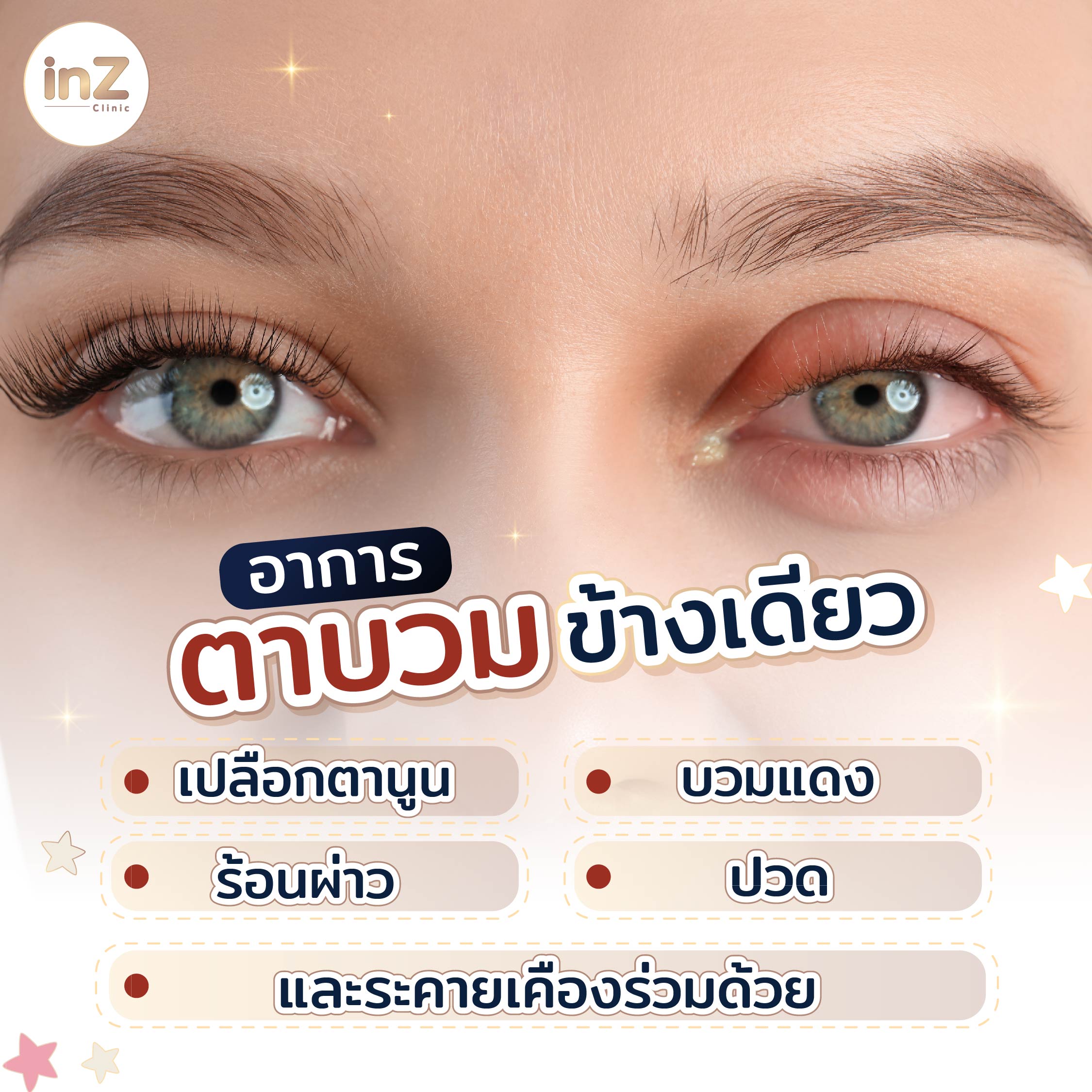 เปลือกตาบวมแดงข้างเดียวเกิดจากอะไร? สาเหตุหลักที่รู้แล้วรักษาได้ - inZ ...