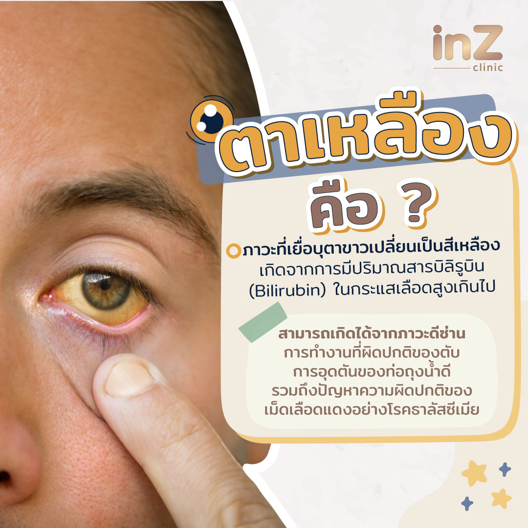 ตาขาวเหลือง สัญญาณเตือนโรคร้าย ดูแลดวงตาอย่างไรให้ขาวใส