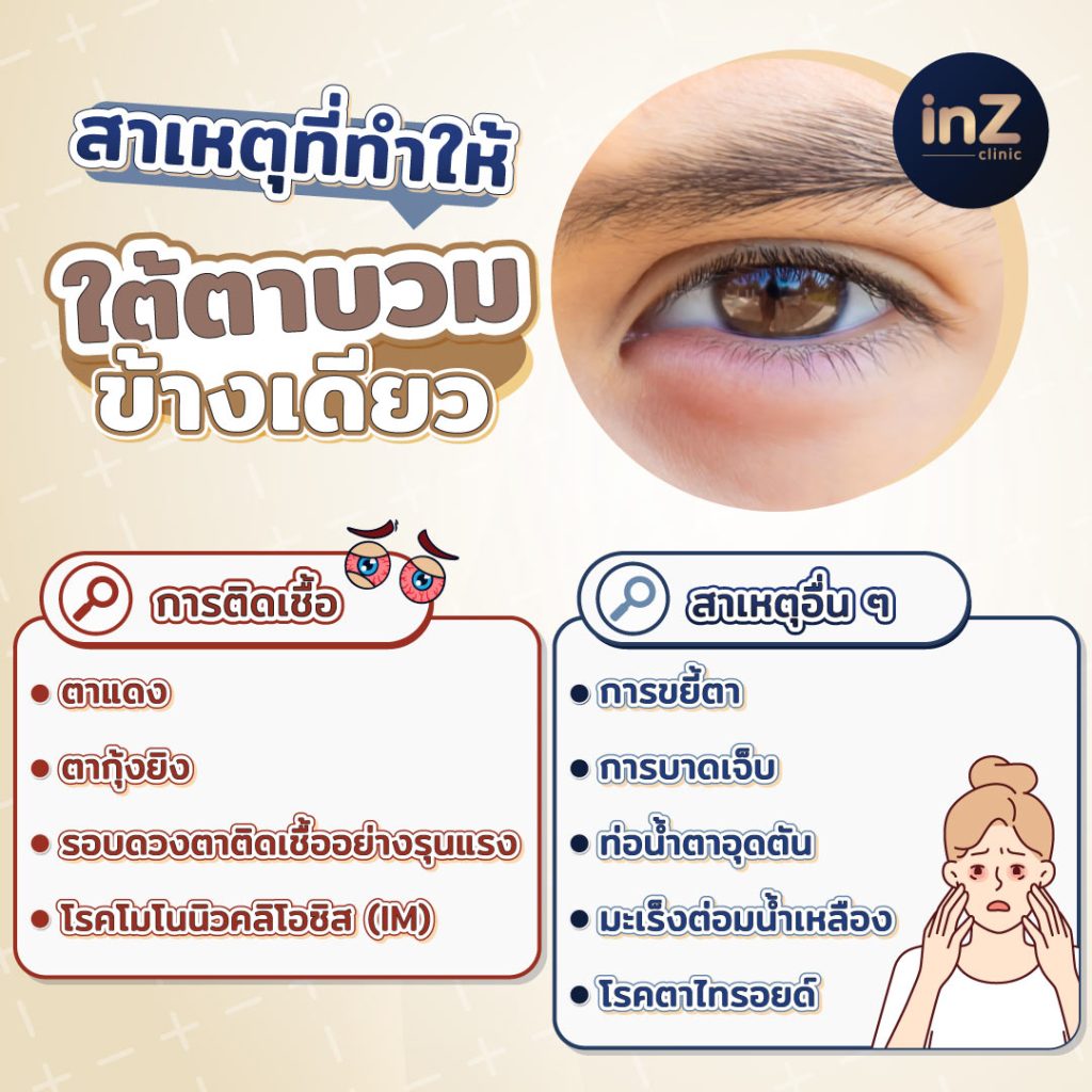 สาเหตุและโรคที่ทำให้เกิดอาการใต้ตาบวมข้างเดียว