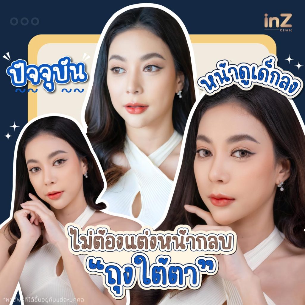 กำจัดถุงใต้ตา