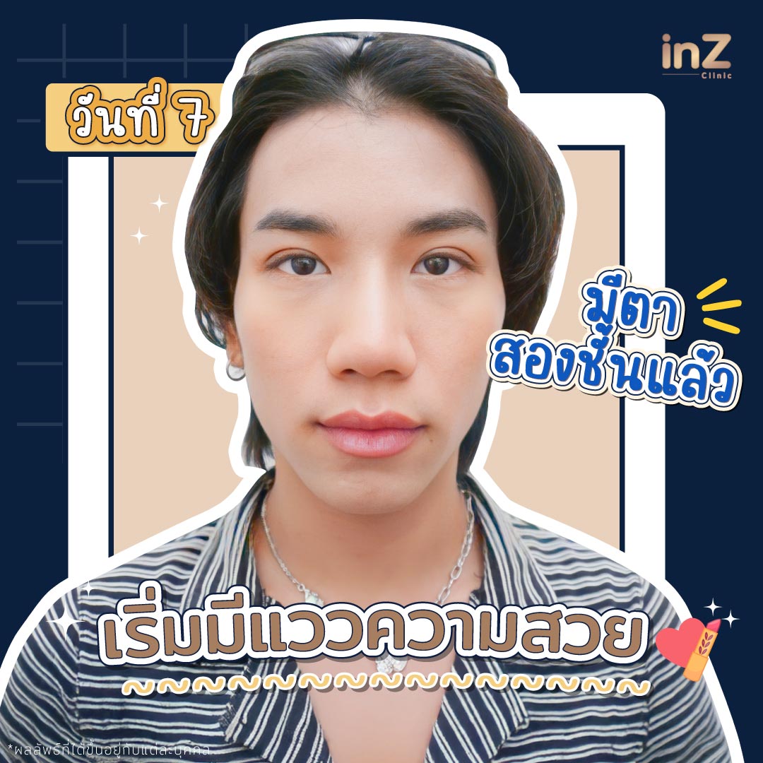 ตาสองชั้นหลังทำทันที