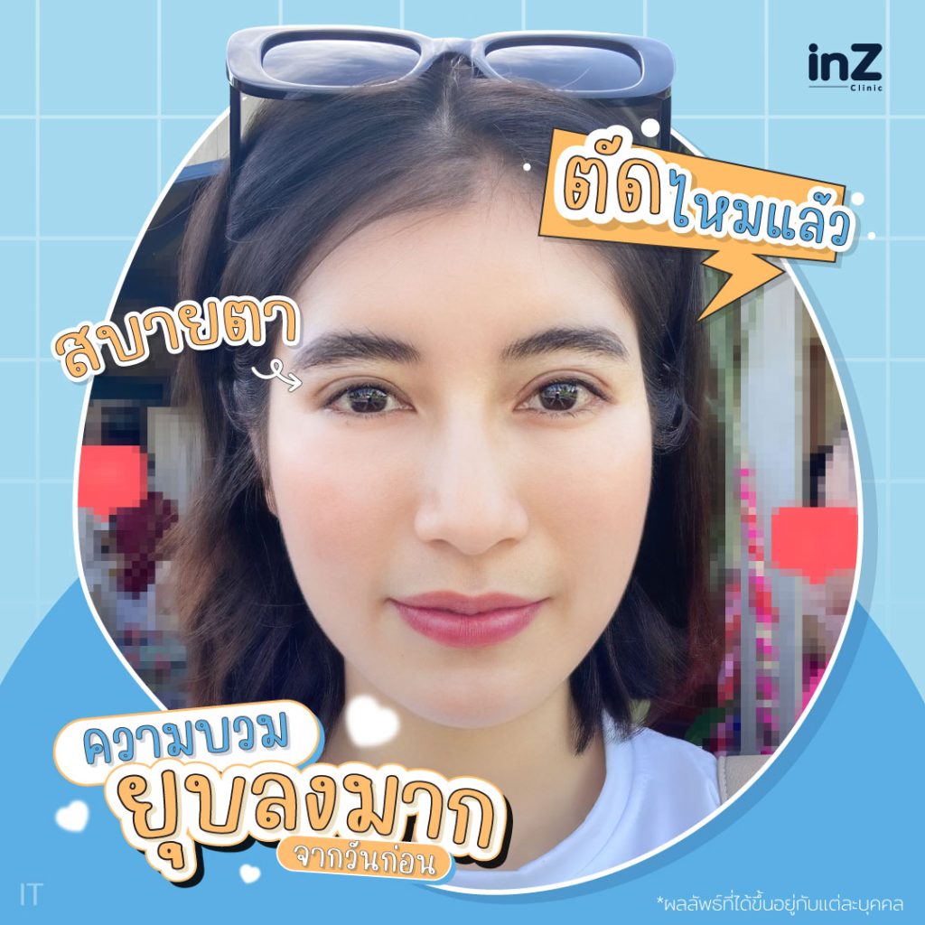 ทำตาสองชั้นหลังทำวันที่ 7 