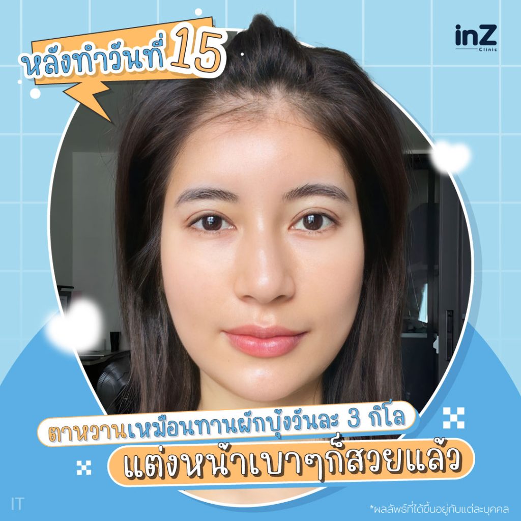 ทำตาสองชั้นหลังทำวันที่ 15
