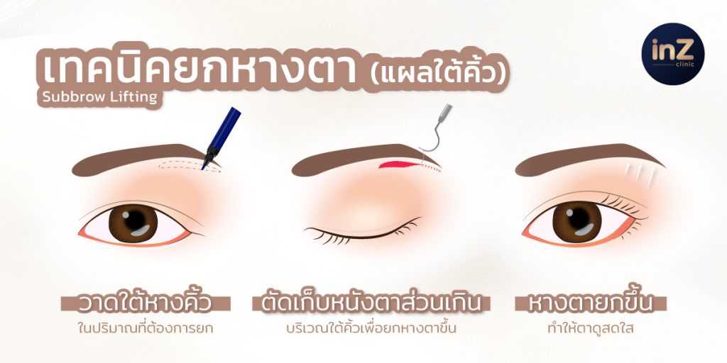 ยกหางตา แก้หางตาตกโดยไม่ต้องทำตาสองชั้น ด้วย Subbrow Lifting