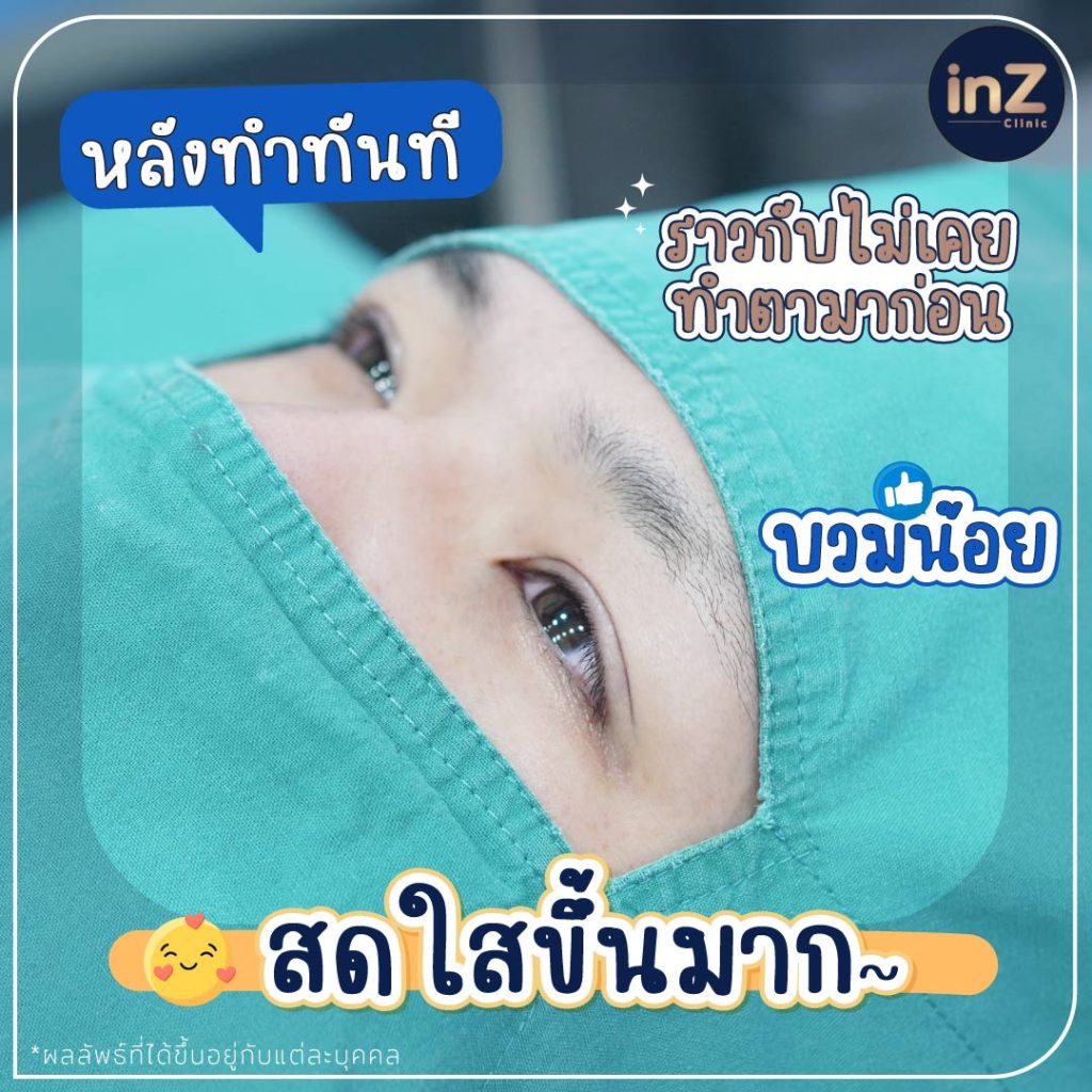 ตาสองชั้นหลังทำทันที