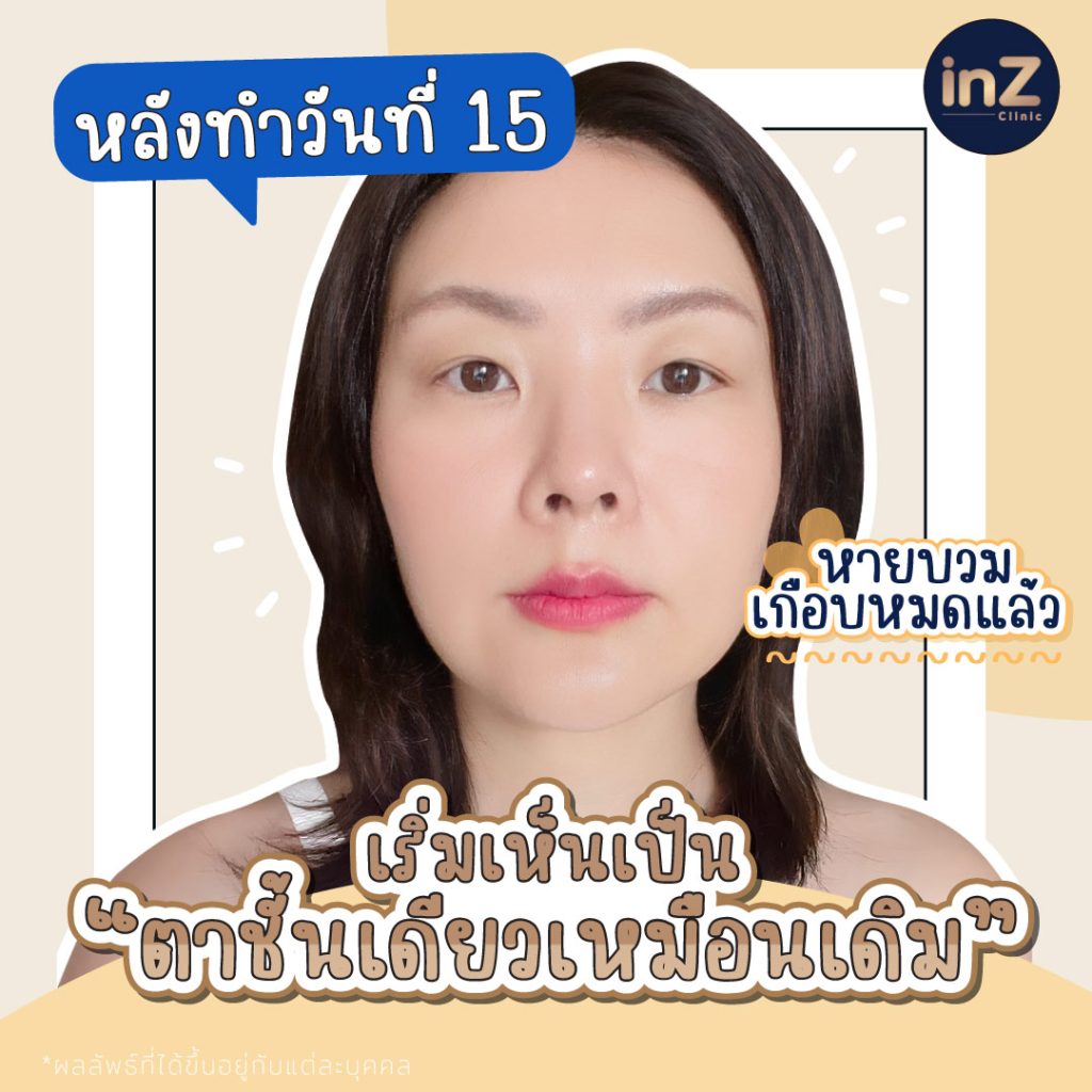 ลุลาทำตาที่ inZ Clinic