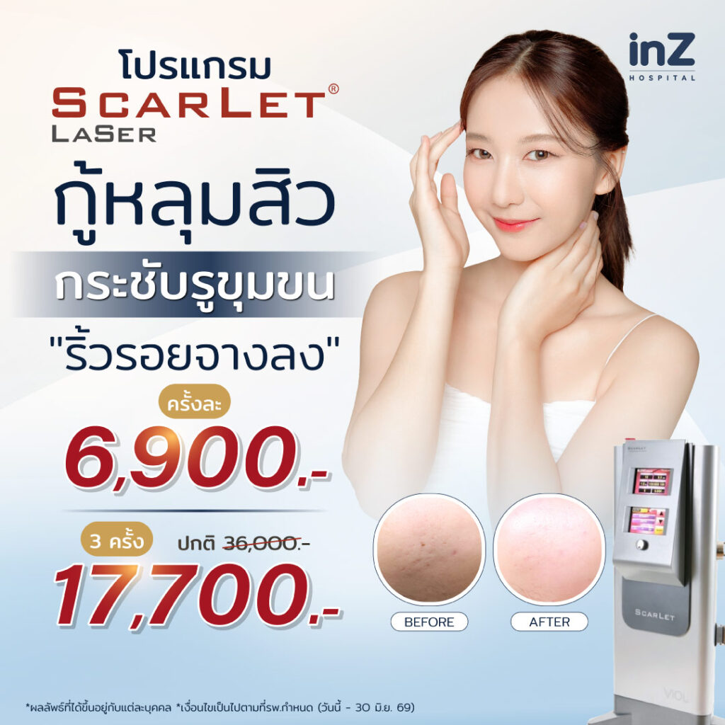 Scarlet Laser เลเซอร์หลุมสิว เผยผิวเรียบเนียน