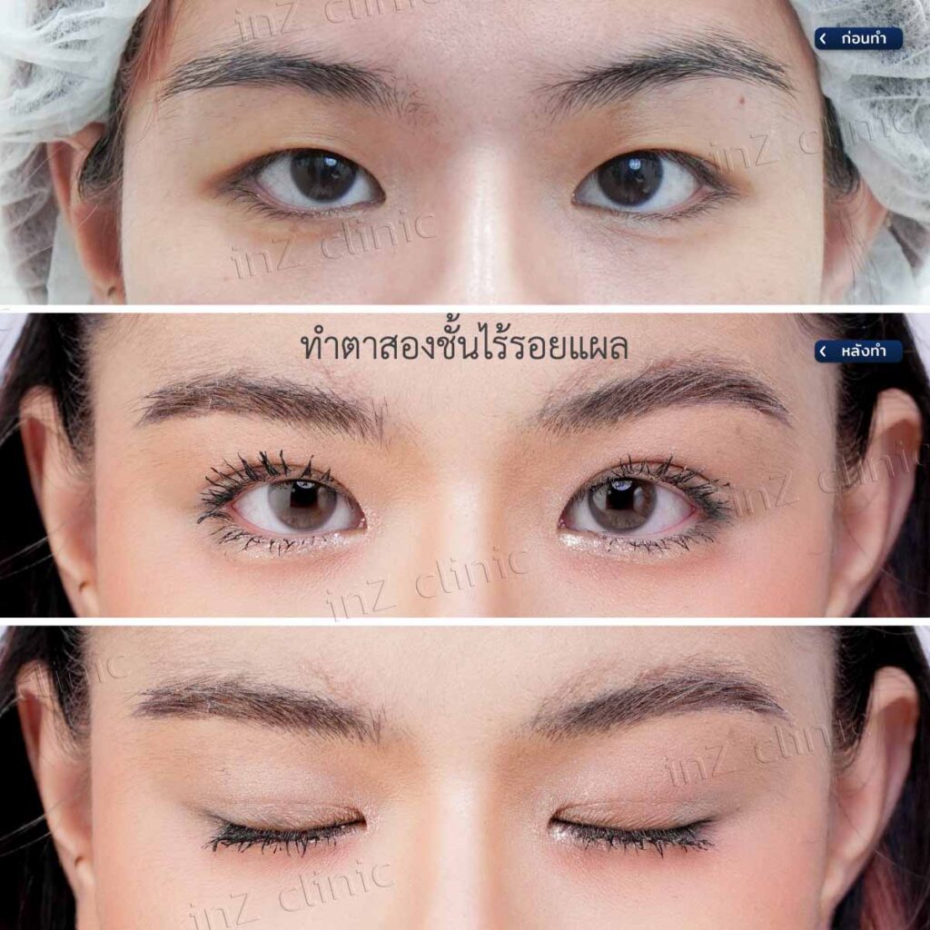 การทำตาสองชั้น วิธีต่างๆ ในปัจจุบัน ข้อดี-ข้อเสีย