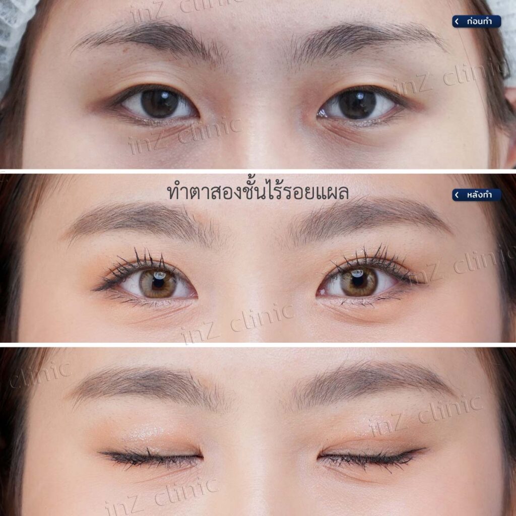 การทำตาสองชั้น วิธีต่างๆ ในปัจจุบัน ข้อดี-ข้อเสีย