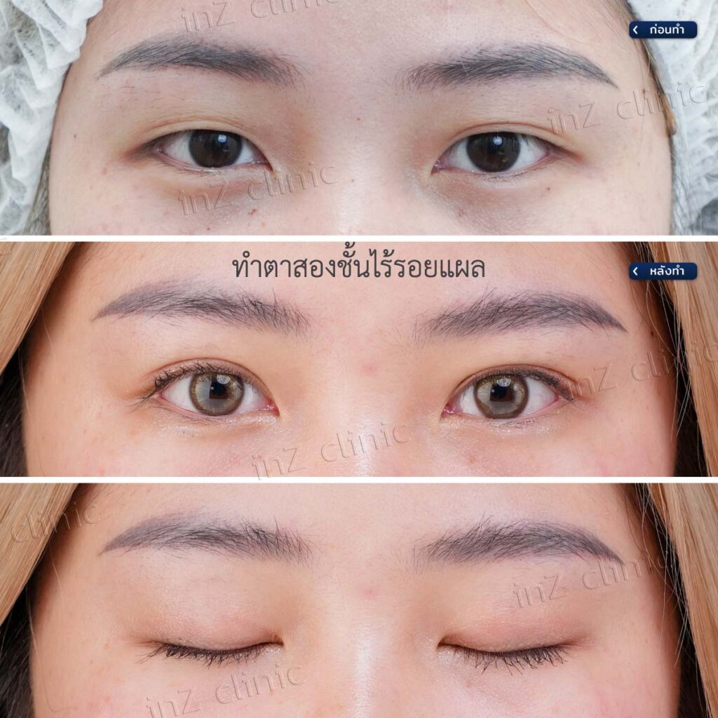 การทำตาสองชั้น วิธีต่างๆ ในปัจจุบัน ข้อดี-ข้อเสีย