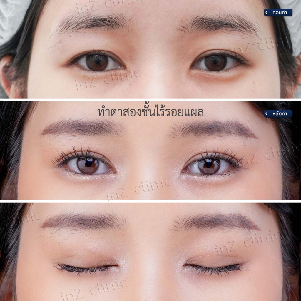การทำตาสองชั้น วิธีต่างๆ ในปัจจุบัน ข้อดี-ข้อเสีย