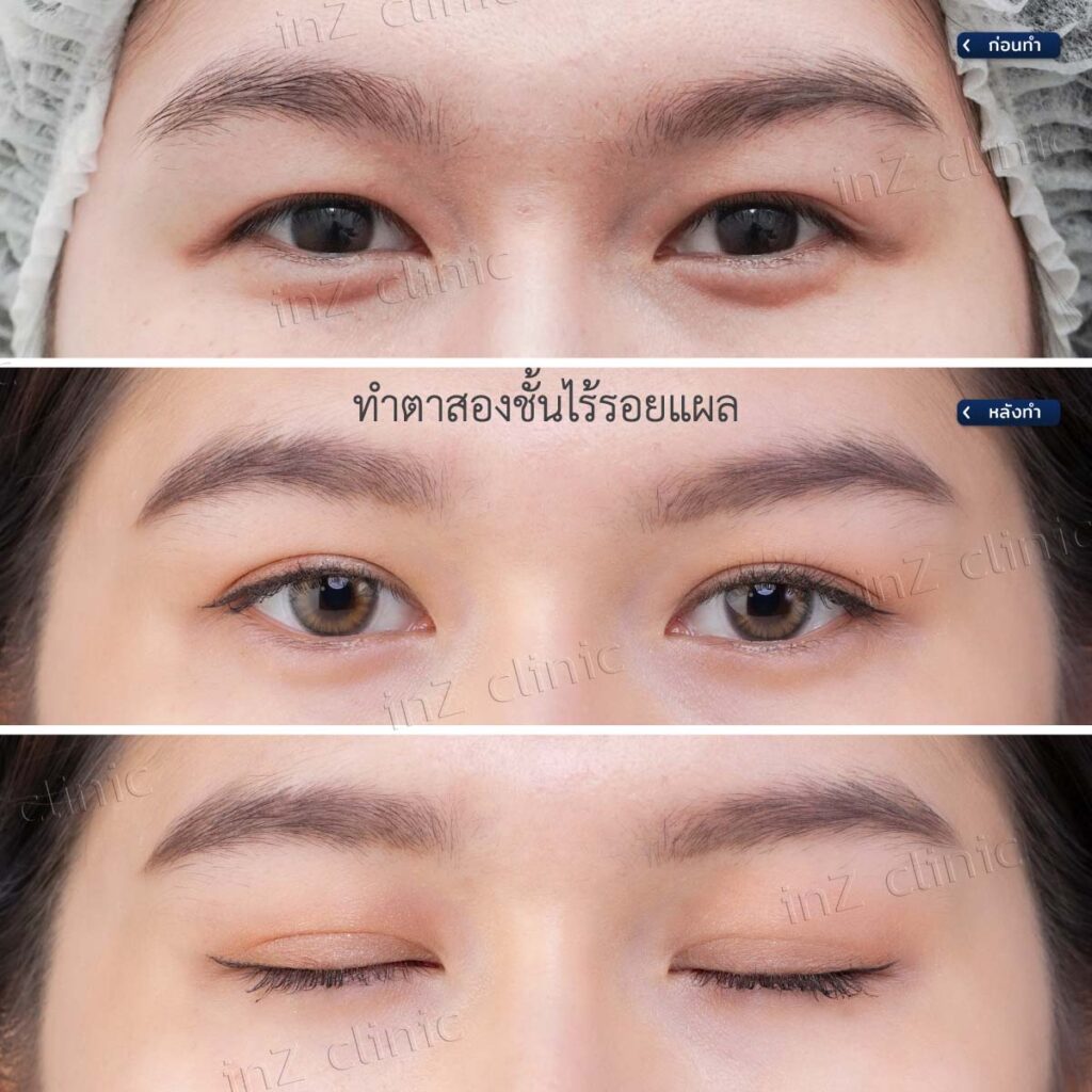 การทำตาสองชั้น วิธีต่างๆ ในปัจจุบัน ข้อดี-ข้อเสีย