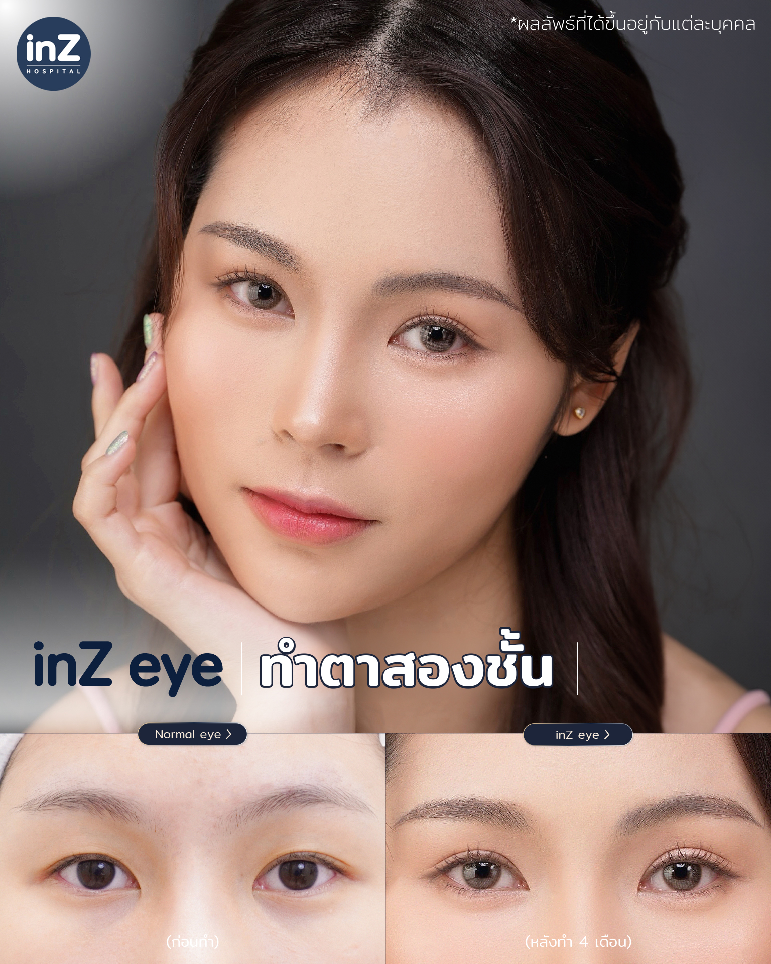การทำตาสองชั้น วิธีต่างๆ ในปัจจุบัน ข้อดี-ข้อเสีย