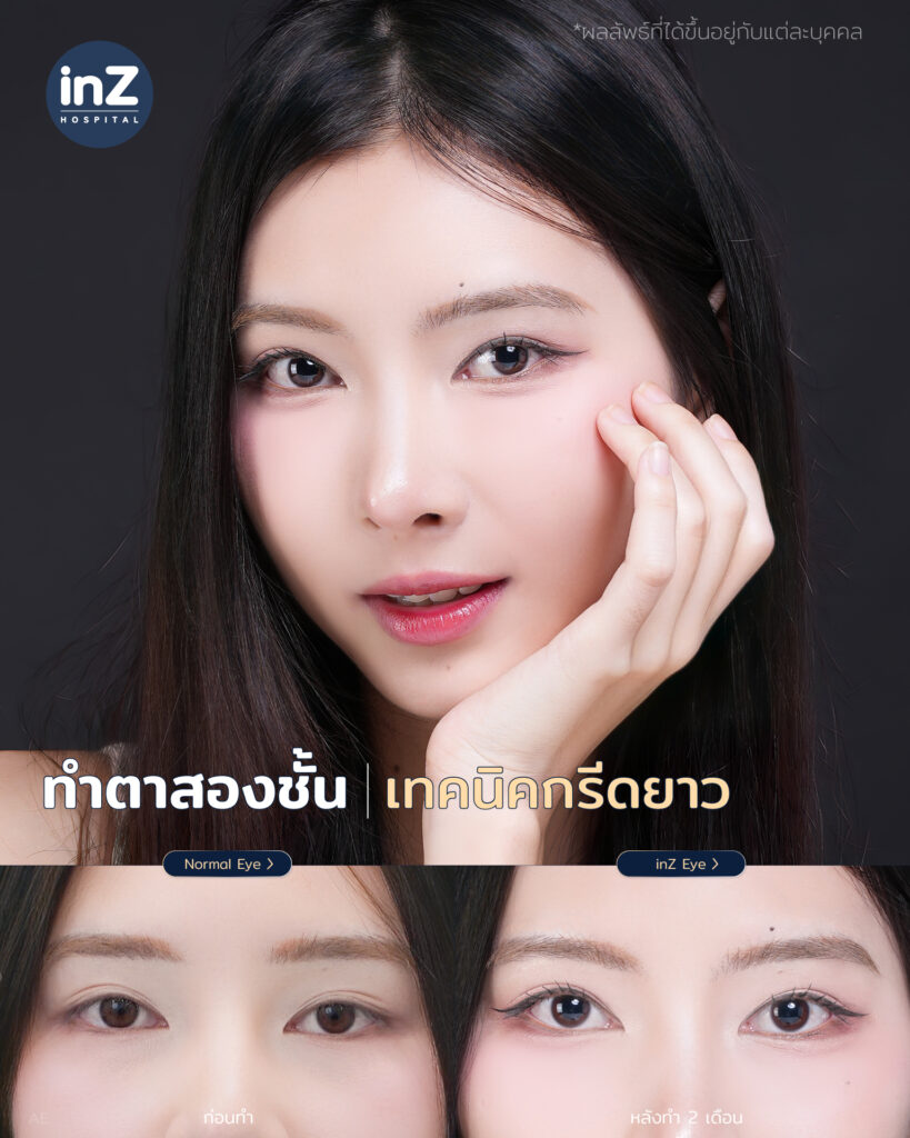 การทำตาสองชั้น วิธีต่างๆ ในปัจจุบัน ข้อดี-ข้อเสีย