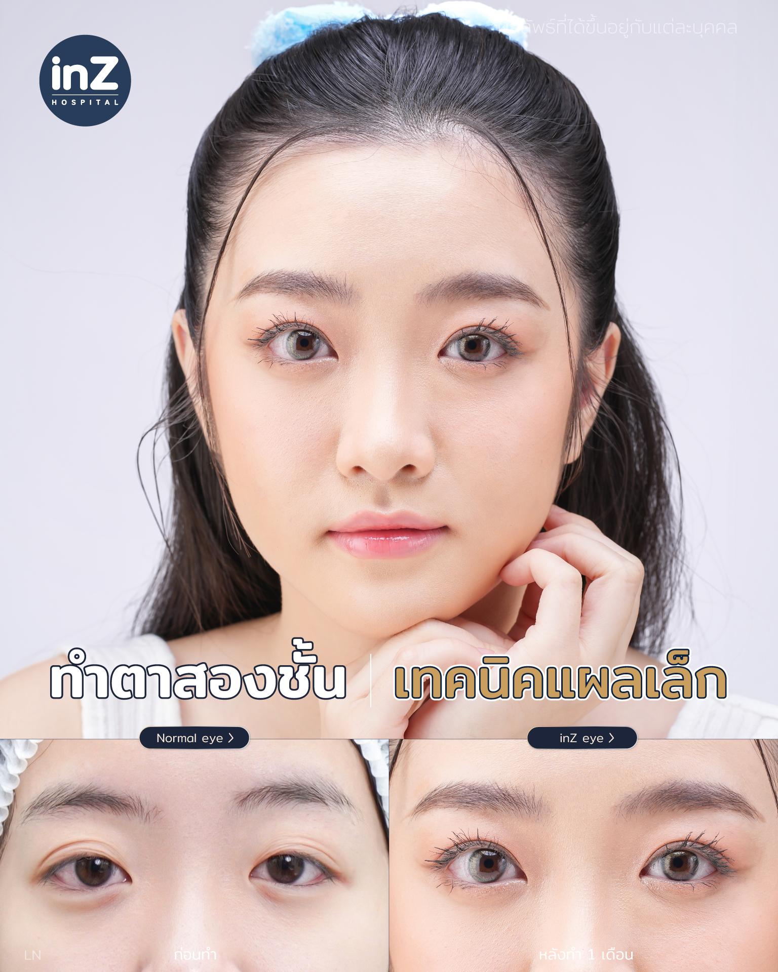การทำตาสองชั้น วิธีต่างๆ ในปัจจุบัน ข้อดี-ข้อเสีย