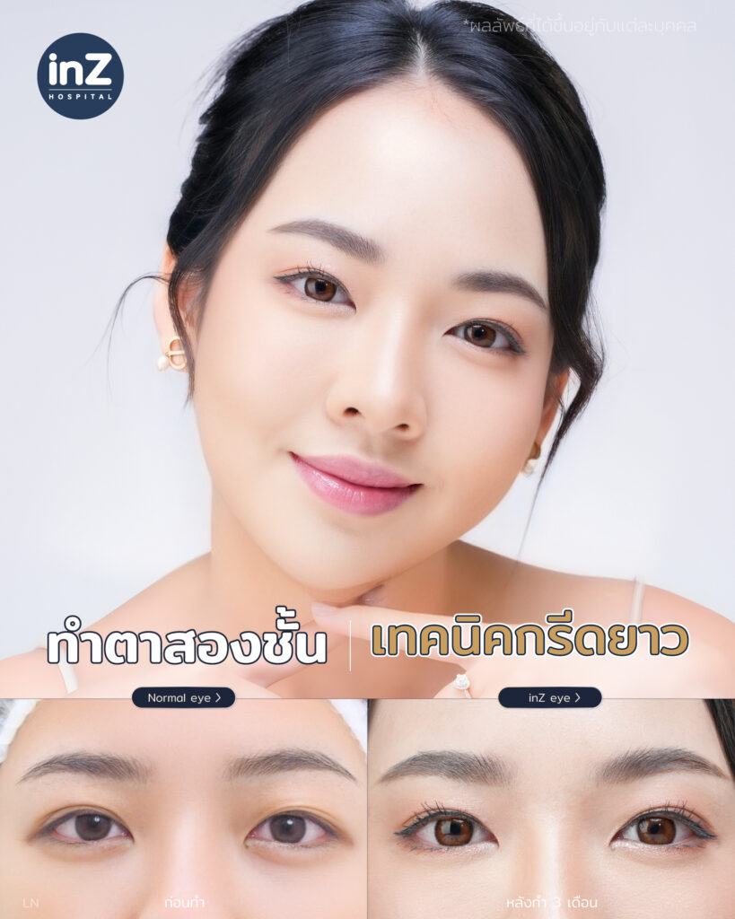 การทำตาสองชั้น วิธีต่างๆ ในปัจจุบัน ข้อดี-ข้อเสีย